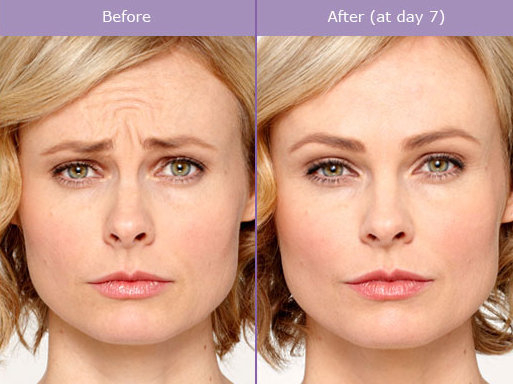 Queens Botox Med Spa B4 & After